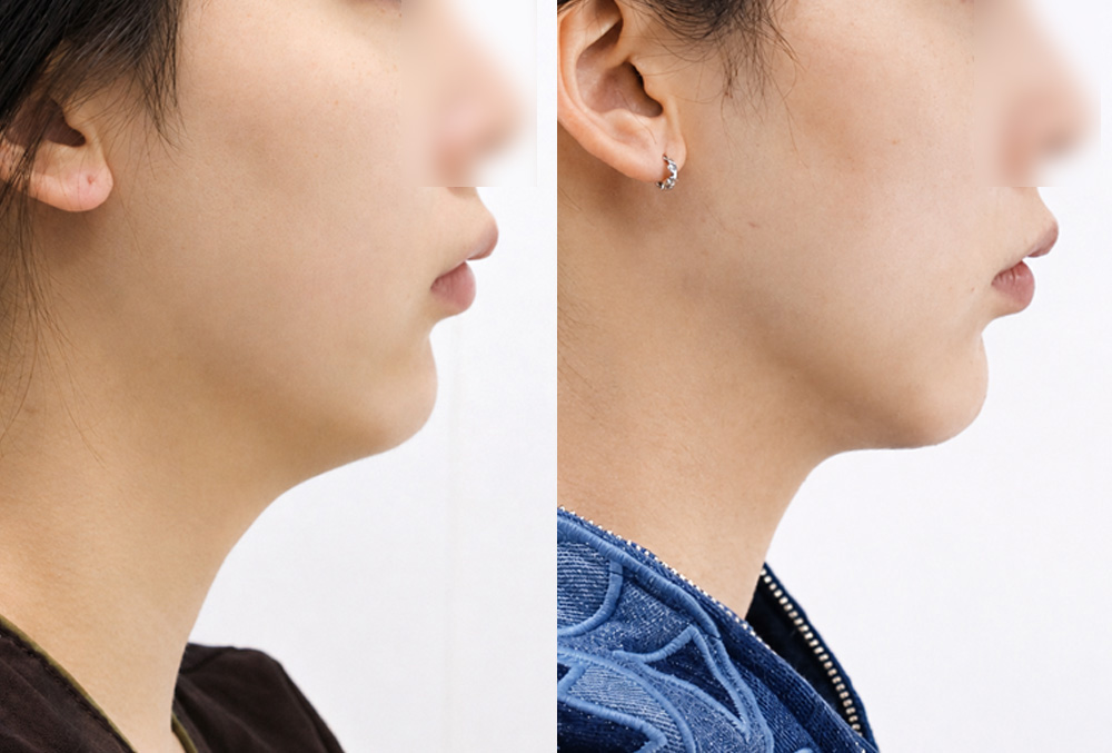 지방흡입+근육묶기 1달 후