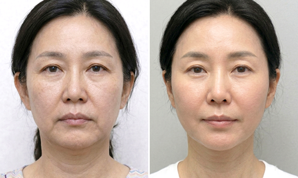 탄력잃은 피부를 자연스럽게 리프팅