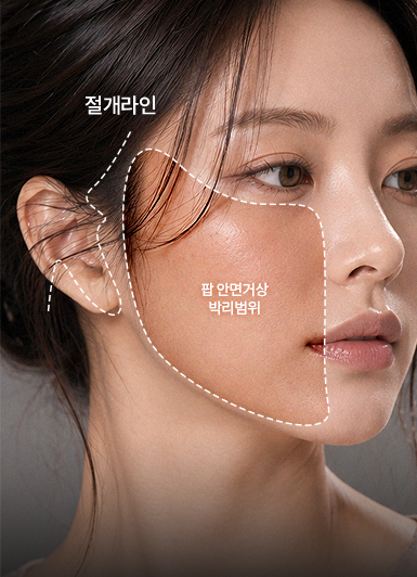100% 1:1 커스텀 리프팅