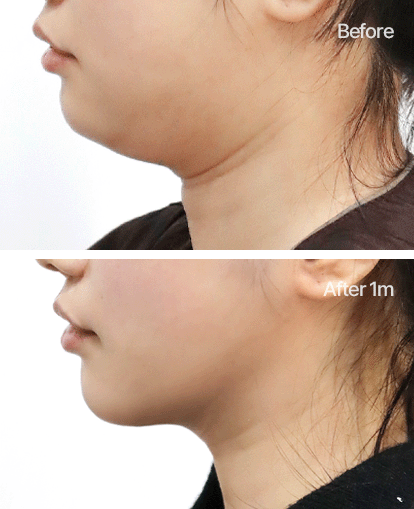 근육 사이와 턱 아래에 지방이 많은 경우