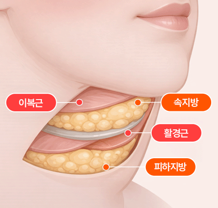 일반 이중턱 수술과 팝 이중턱 수술과 차이점