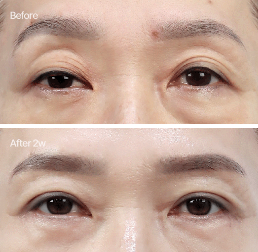 눈위지방제거 or 눈위지방재배치 상안검과 함께한 수술 전후