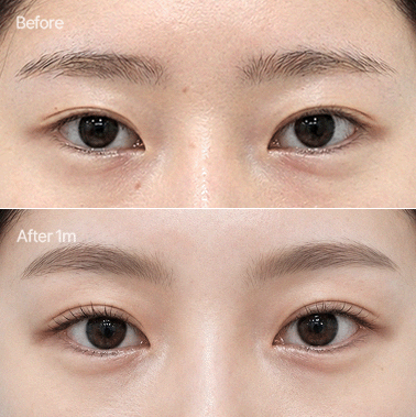 이마거상+자연유착+앞트임+윗트임