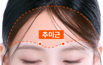 추미근 절제