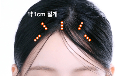 1:1 맞춤 최소 절개