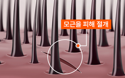 모근을 살리는 사선 절개